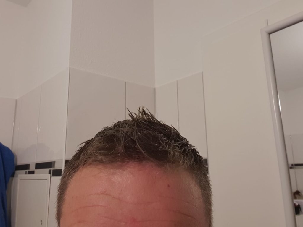 Nach der Anwendung mit Toppik sind die Geheimratsecken verschwunden.